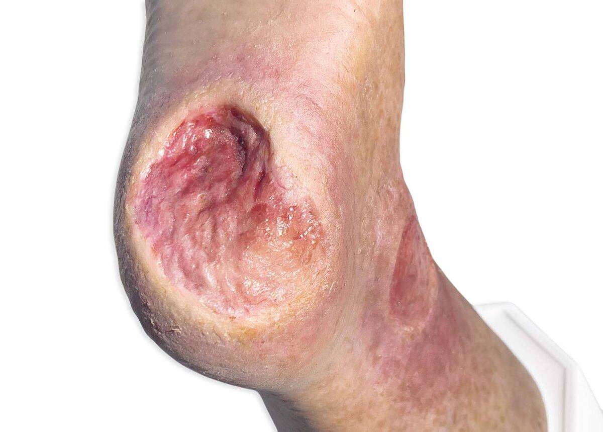 Das „Sockelmodell Zwei-Zehen-Fuß mit 6 Wunden“ von MEDICAL FX Germany präsentiert eine detailreiche Darstellung eines Fußes mit zwei verbliebenen Zehen und sechs verschiedenen Wun…