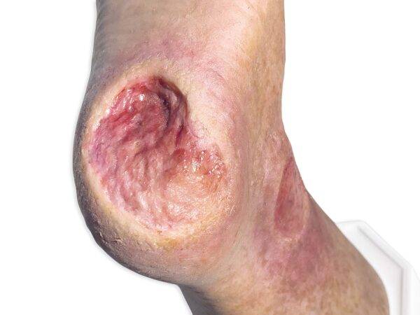 Das „Sockelmodell Zwei-Zehen-Fuß mit 6 Wunden“ von MEDICAL FX Germany präsentiert eine detailreiche Darstellung eines Fußes mit zwei verbliebenen Zehen und sechs verschiedenen Wun…