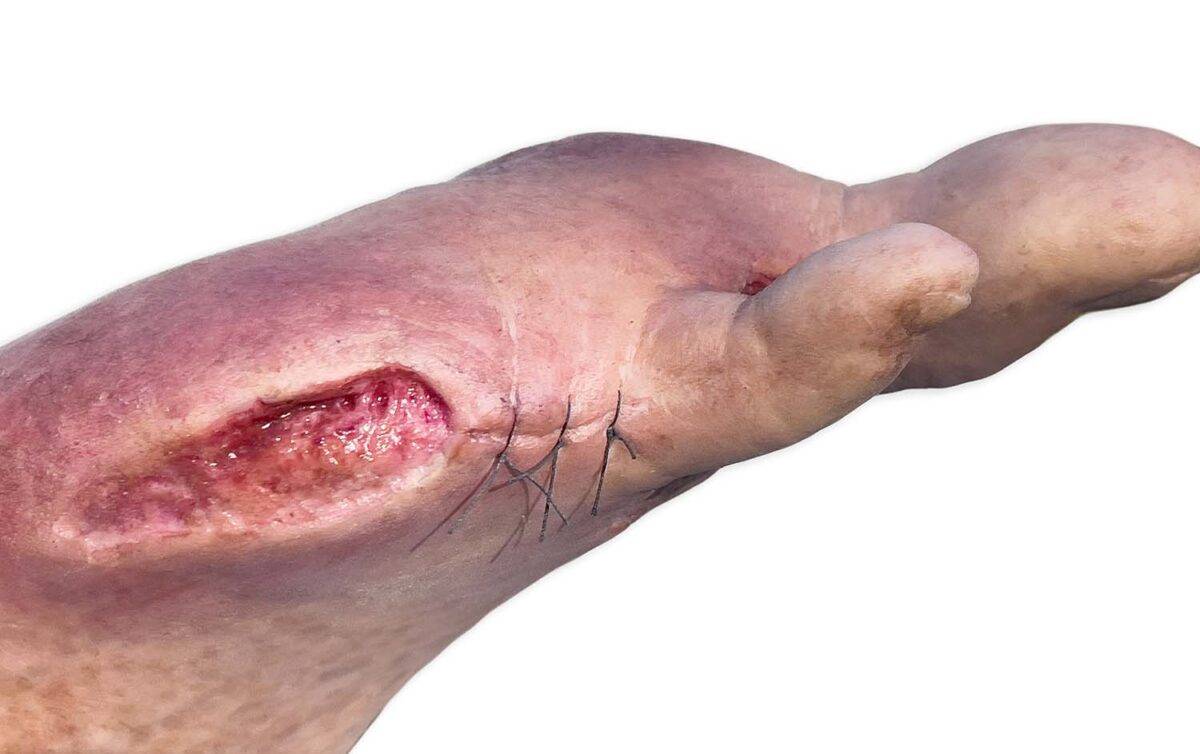 Das „Sockelmodell Zwei-Zehen-Fuß mit 6 Wunden“ von MEDICAL FX Germany präsentiert eine detailreiche Darstellung eines Fußes mit zwei verbliebenen Zehen und sechs verschiedenen Wun…