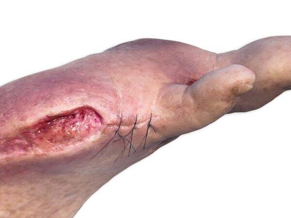 Das „Sockelmodell Zwei-Zehen-Fuß mit 6 Wunden“ von MEDICAL FX Germany präsentiert eine detailreiche Darstellung eines Fußes mit zwei verbliebenen Zehen und sechs verschiedenen Wun…