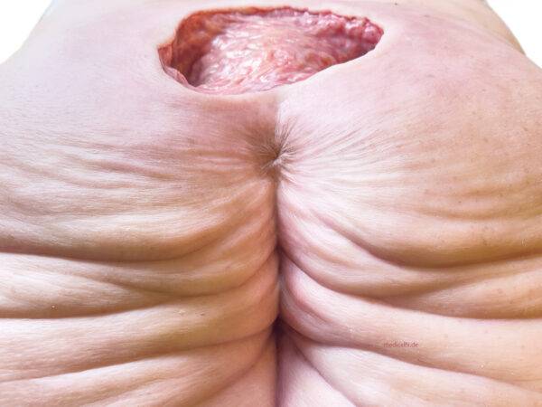 Das „Rahmenmodell Gesäß-Dekubitus" von MEDICAL FX Germany ist eine präzise Nachbildung eines fortgeschrittenen Druckgeschwürs im Sakralbereich, gefertigt aus hochwertigem Silikon.…