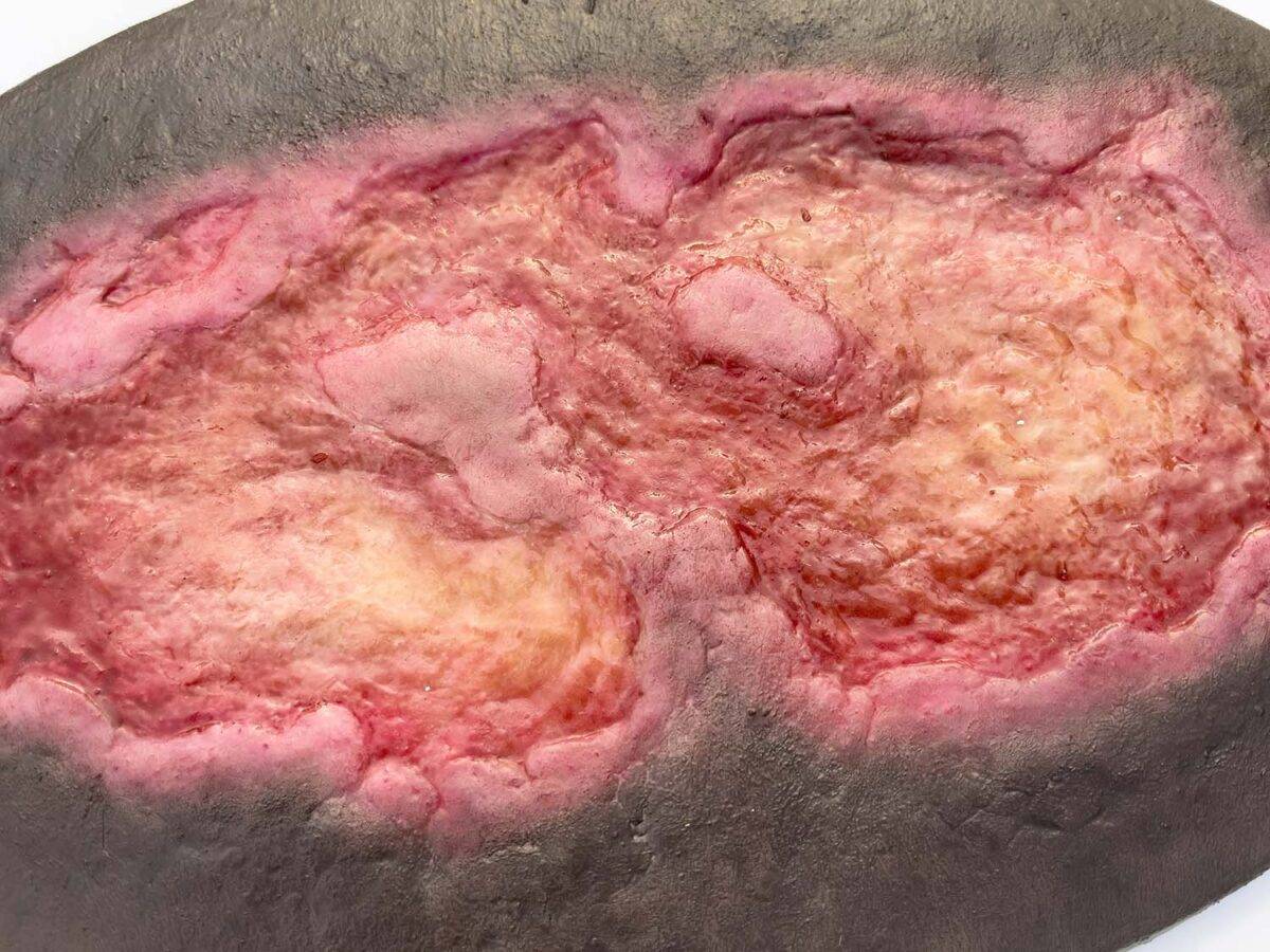 Das Modell „Stick-On Large Ulcus Cruris" von MEDICAL FX Germany simuliert ein großflächiges Unterschenkelgeschwür, typisch für venöse Insuffizienzen oder andere zirkulatorische Er…