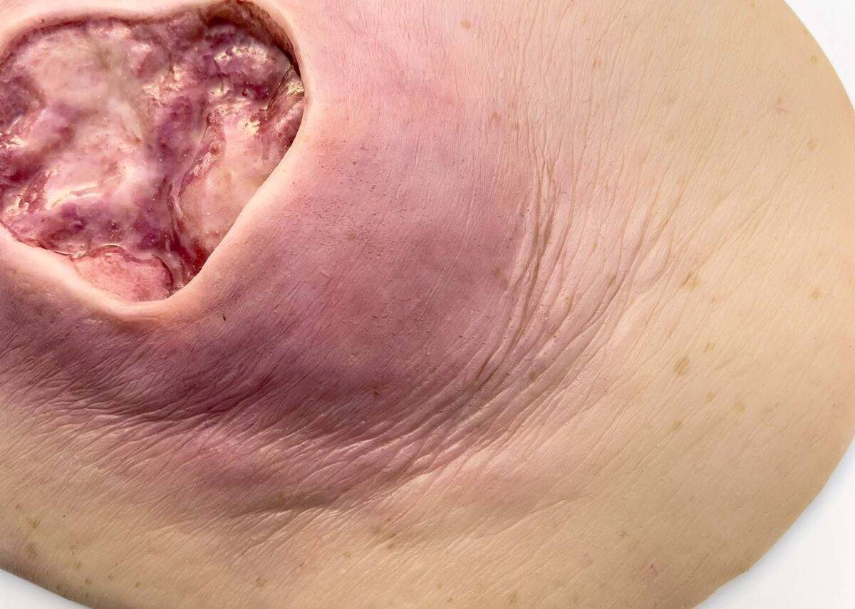 Das „Stick-On Medium Dekubitus Grad 3"-Modell von MEDICAL FX Germany ist eine detailgetreue Nachbildung einer Druckgeschwür-Wunde, wie sie im Stadium 3 auftritt. Eingebettet in ho…