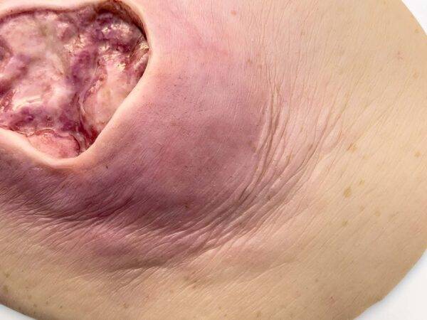 Das „Stick-On Medium Dekubitus Grad 3"-Modell von MEDICAL FX Germany ist eine detailgetreue Nachbildung einer Druckgeschwür-Wunde, wie sie im Stadium 3 auftritt. Eingebettet in ho…