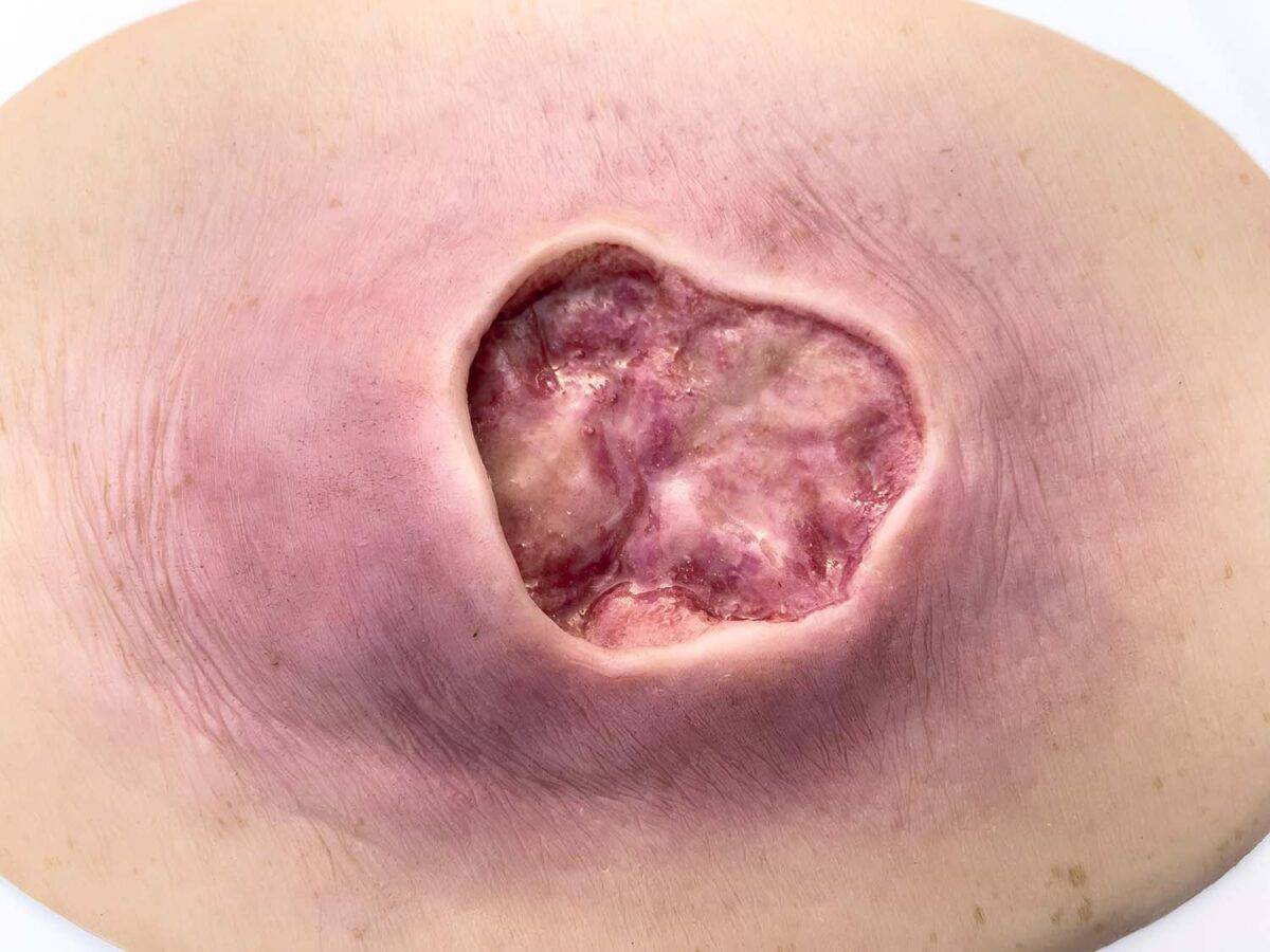 Das „Stick-On Medium Dekubitus Grad 3"-Modell von MEDICAL FX Germany ist eine detailgetreue Nachbildung einer Druckgeschwür-Wunde, wie sie im Stadium 3 auftritt. Eingebettet in ho…