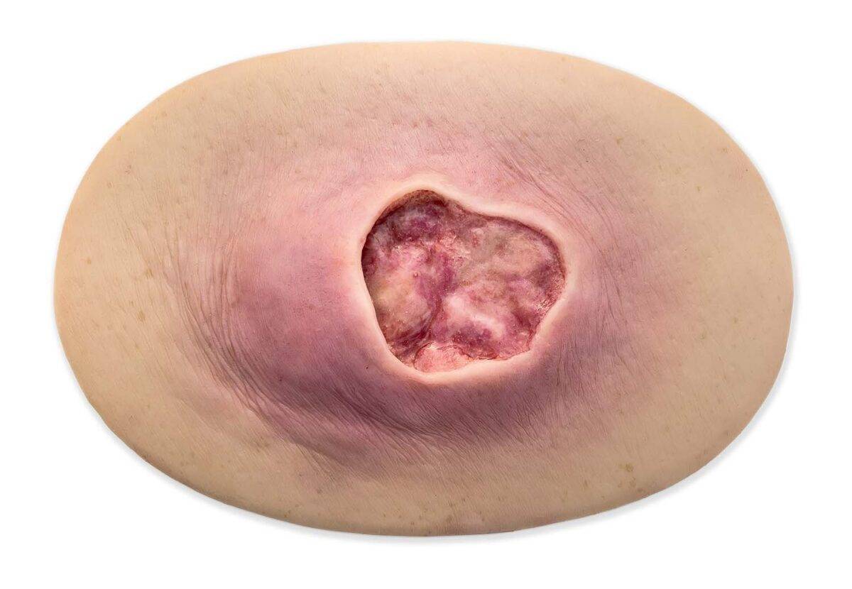 Das „Stick-On Medium Dekubitus Grad 3"-Modell von MEDICAL FX Germany ist eine detailgetreue Nachbildung einer Druckgeschwür-Wunde, wie sie im Stadium 3 auftritt. Eingebettet in ho…