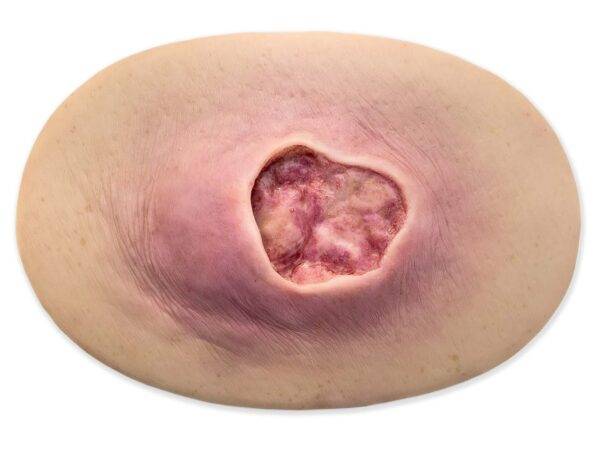 Das „Stick-On Medium Dekubitus Grad 3"-Modell von MEDICAL FX Germany ist eine detailgetreue Nachbildung einer Druckgeschwür-Wunde, wie sie im Stadium 3 auftritt. Eingebettet in ho…