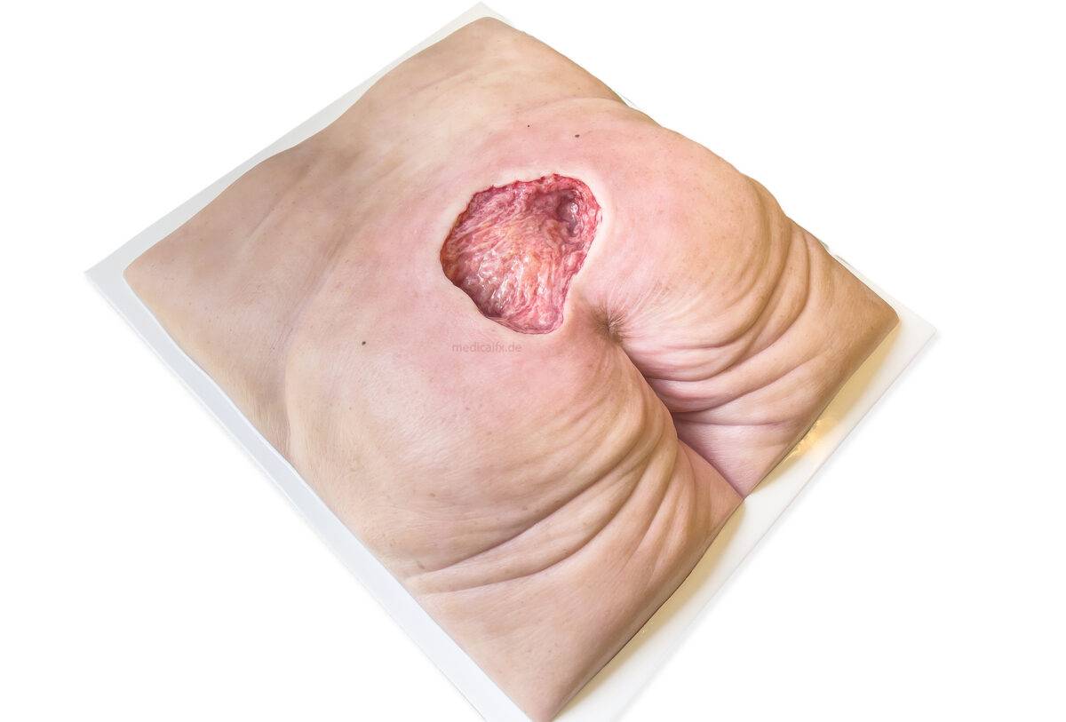 Das „Rahmenmodell Gesäß-Dekubitus" von MEDICAL FX Germany ist eine präzise Nachbildung eines fortgeschrittenen Druckgeschwürs im Sakralbereich, gefertigt aus hochwertigem Silikon.…