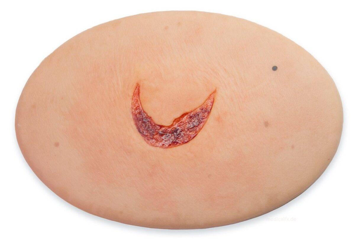 Das „Stick-On Medium Offene Ablederung" (Skin Tears)-Modell von MEDICAL FX Germany ist ein spezialisiertes, mittelgroßes Silikonmodell, das die Herausforderungen in der Behandlung…