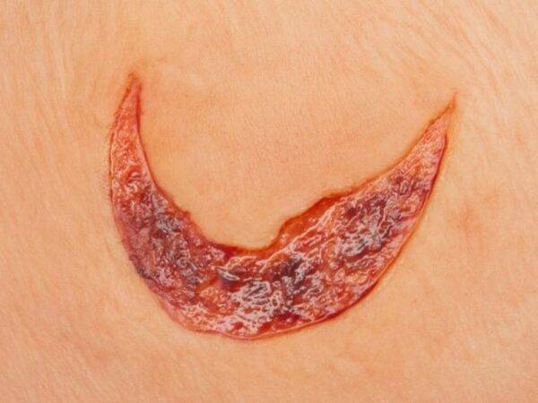 Das „Stick-On Medium Offene Ablederung" (Skin Tears)-Modell von MEDICAL FX Germany ist ein spezialisiertes, mittelgroßes Silikonmodell, das die Herausforderungen in der Behandlung…