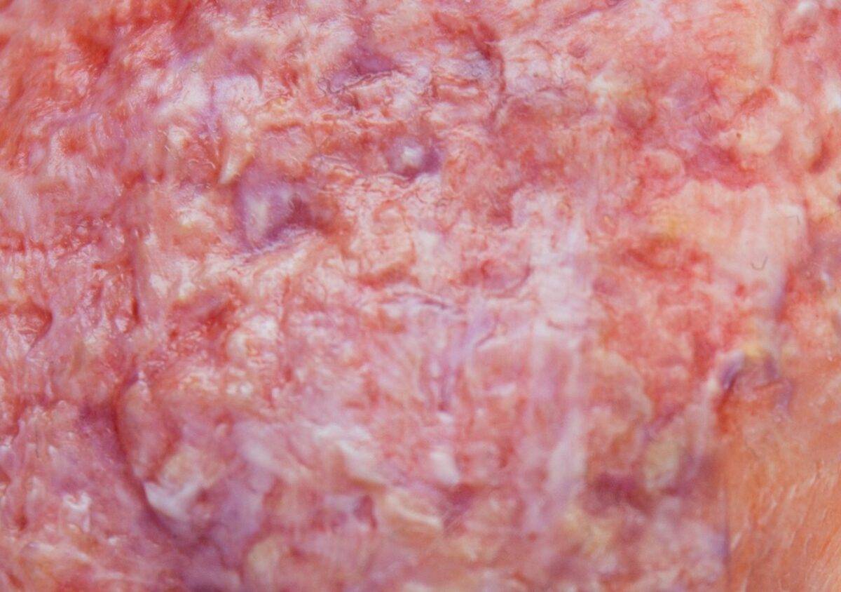 Das "Stick-On Medium Ulcerierendes Mamma-CA"-Modell von MEDICAL FX Germany simuliert ein fortgeschrittenes, ulzerierendes Brustkrebsgeschwür mit hoher Detailgenauigkeit und ist au…