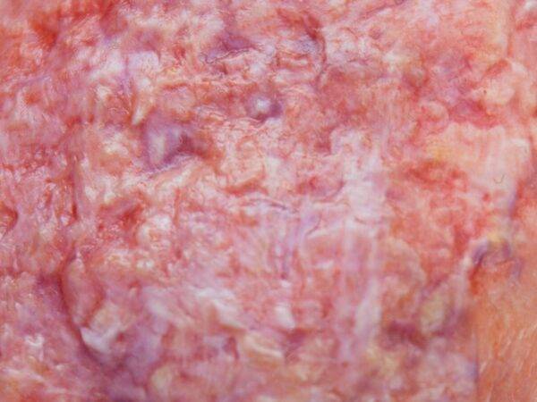 Das "Stick-On Medium Ulcerierendes Mamma-CA"-Modell von MEDICAL FX Germany simuliert ein fortgeschrittenes, ulzerierendes Brustkrebsgeschwür mit hoher Detailgenauigkeit und ist au…