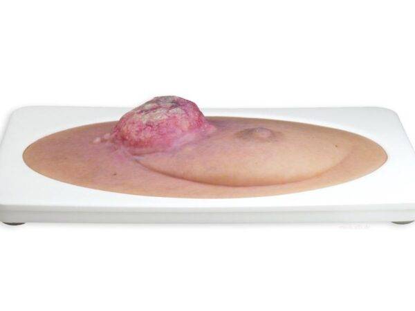 Das "Stick-On Medium Ulcerierendes Mamma-CA"-Modell von MEDICAL FX Germany simuliert ein fortgeschrittenes, ulzerierendes Brustkrebsgeschwür mit hoher Detailgenauigkeit und ist au…