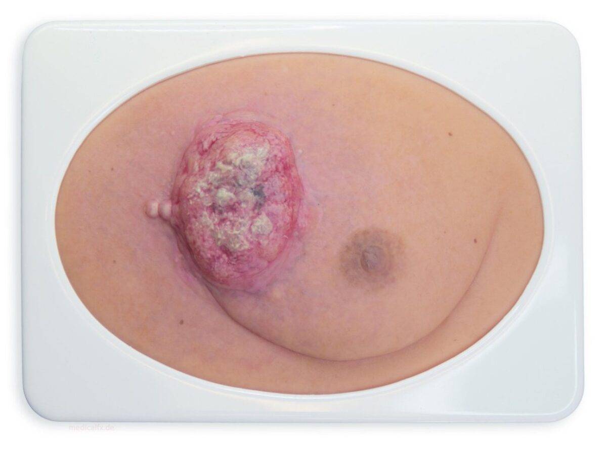 Das "Stick-On Medium Ulcerierendes Mamma-CA"-Modell von MEDICAL FX Germany simuliert ein fortgeschrittenes, ulzerierendes Brustkrebsgeschwür mit hoher Detailgenauigkeit und ist au…