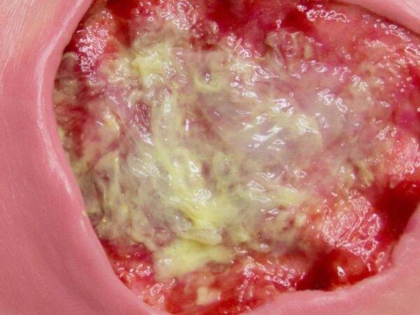 Das „Stick-On Medium Dekubitus Grad 3"-Modell von MEDICAL FX Germany ist eine detailgetreue Nachbildung einer Druckgeschwür-Wunde, wie sie im Stadium 3 auftritt. Eingebettet in ho…