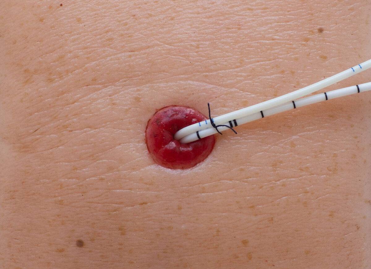 Das „Rahmenmodell Stoma auf Hautniveau“ von MEDICAL FX Germany bietet eine präzise und naturgetreue Darstellung eines Stomas, das exakt auf Hautniveau angelegt ist. Dieses Modell…