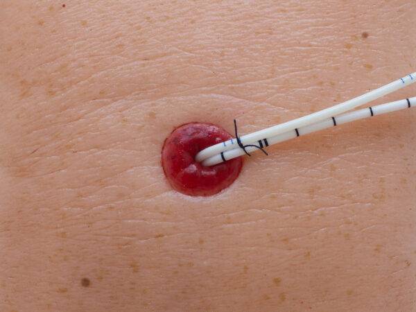 Das „Rahmenmodell Stoma auf Hautniveau“ von MEDICAL FX Germany bietet eine präzise und naturgetreue Darstellung eines Stomas, das exakt auf Hautniveau angelegt ist. Dieses Modell…