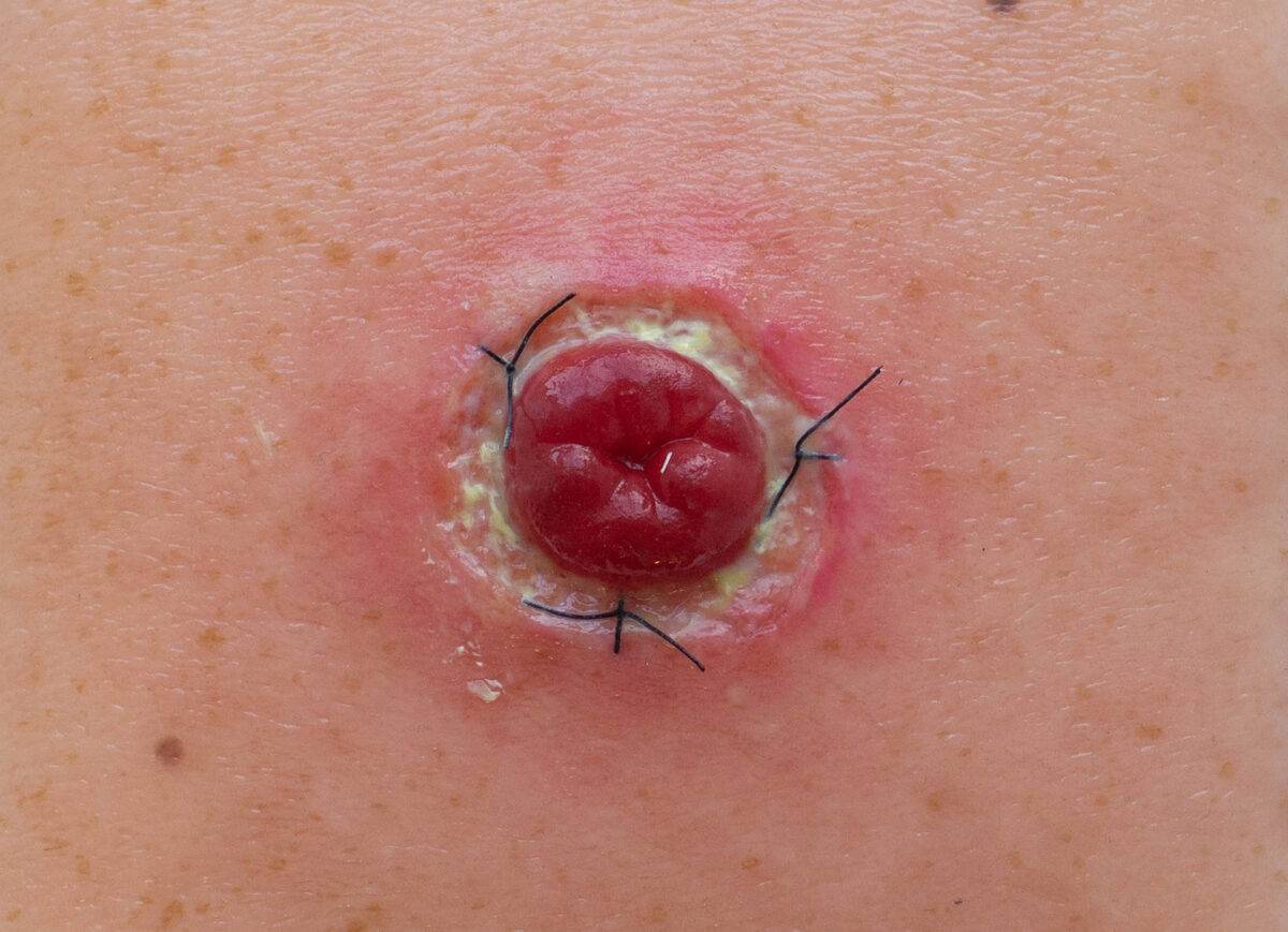 Das „Rahmenmodell Stoma mit Nahtdehiszenz" von MEDICAL FX Germany bietet eine hochpräzise Darstellung eines Stomas, bei dem eine Nahtdehiszenz aufgetreten ist. Dieses Modell ist i…