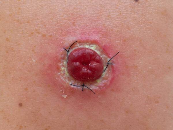 Das „Rahmenmodell Stoma mit Nahtdehiszenz" von MEDICAL FX Germany bietet eine hochpräzise Darstellung eines Stomas, bei dem eine Nahtdehiszenz aufgetreten ist. Dieses Modell ist i…