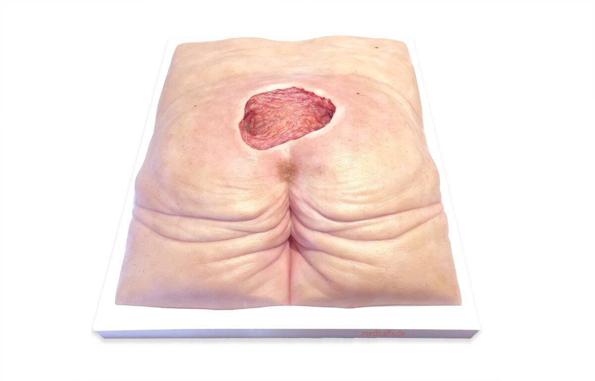 Das „Rahmenmodell Gesäß-Dekubitus" von MEDICAL FX Germany ist eine präzise Nachbildung eines fortgeschrittenen Druckgeschwürs im Sakralbereich, gefertigt aus hochwertigem Silikon.…