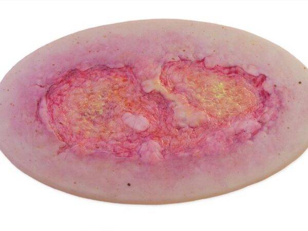 Das Modell „Stick-On Large Ulcus Cruris" von MEDICAL FX Germany simuliert ein großflächiges Unterschenkelgeschwür, typisch für venöse Insuffizienzen oder andere zirkulatorische Er…