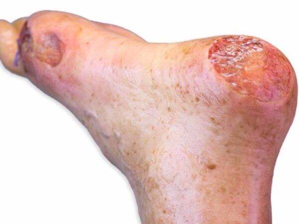 Das "Sockelmodell Bein mit 7 flachen Wunden" von MEDICAL FX Germany ist ein exzellentes Lehr- und Übungsinstrument für medizinisches Fachpersonal, um ein breites Spektrum an Wundv…