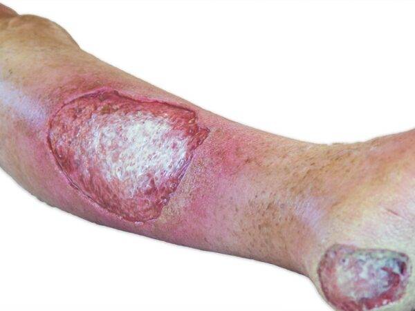 Das „Sockelmodell Bein mit 7 tiefen Wunden" von MEDICAL FX Germany ist ein exzellentes Lehr- und Übungsinstrument für medizinisches Fachpersonal, um ein breites Spektrum an Wundve…