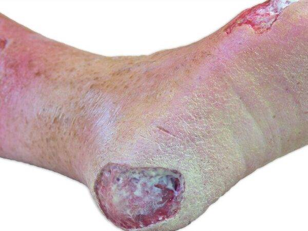 Das „Sockelmodell Bein mit 7 tiefen Wunden" von MEDICAL FX Germany ist ein exzellentes Lehr- und Übungsinstrument für medizinisches Fachpersonal, um ein breites Spektrum an Wundve…