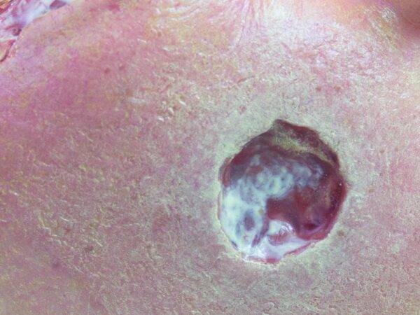 Das „Sockelmodell Bein mit 7 tiefen Wunden" von MEDICAL FX Germany ist ein exzellentes Lehr- und Übungsinstrument für medizinisches Fachpersonal, um ein breites Spektrum an Wundve…