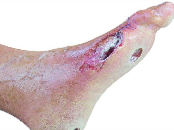 Das „Sockelmodell Bein mit 7 tiefen Wunden" von MEDICAL FX Germany ist ein exzellentes Lehr- und Übungsinstrument für medizinisches Fachpersonal, um ein breites Spektrum an Wundve…