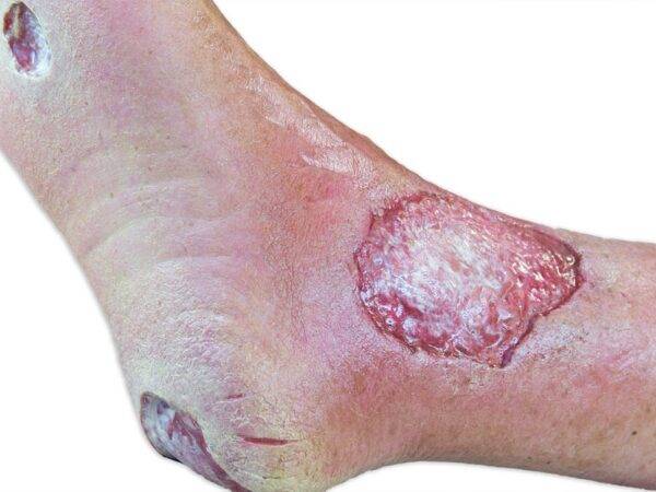 Das „Sockelmodell Bein mit 7 tiefen Wunden" von MEDICAL FX Germany ist ein exzellentes Lehr- und Übungsinstrument für medizinisches Fachpersonal, um ein breites Spektrum an Wundve…