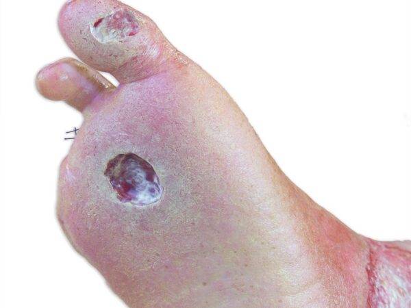 Das „Sockelmodell Bein mit 7 tiefen Wunden" von MEDICAL FX Germany ist ein exzellentes Lehr- und Übungsinstrument für medizinisches Fachpersonal, um ein breites Spektrum an Wundve…