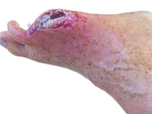 Das „Sockelmodell Bein mit 7 tiefen Wunden" von MEDICAL FX Germany ist ein exzellentes Lehr- und Übungsinstrument für medizinisches Fachpersonal, um ein breites Spektrum an Wundve…