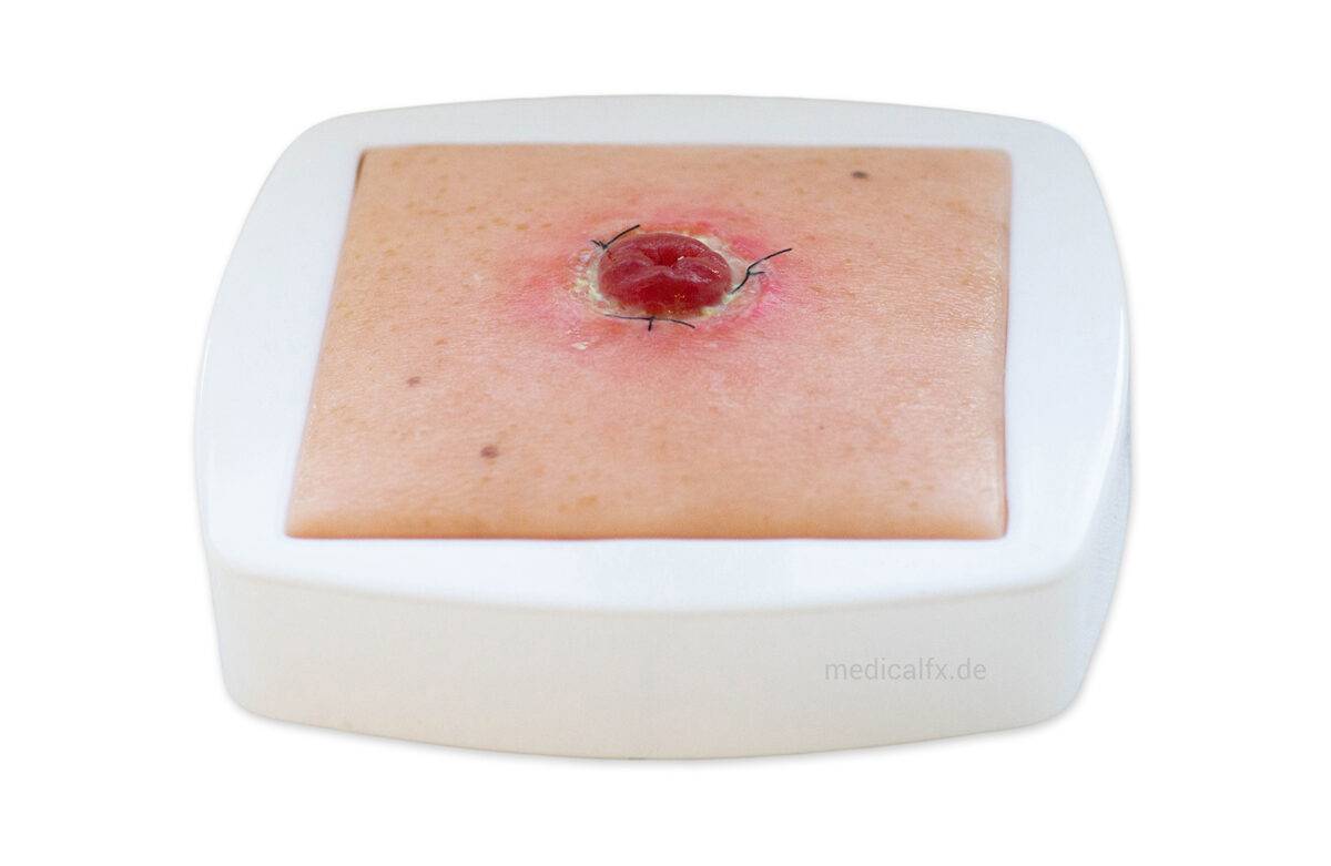 Das „Rahmenmodell Stoma mit Nahtdehiszenz" von MEDICAL FX Germany bietet eine hochpräzise Darstellung eines Stomas, bei dem eine Nahtdehiszenz aufgetreten ist. Dieses Modell ist i…