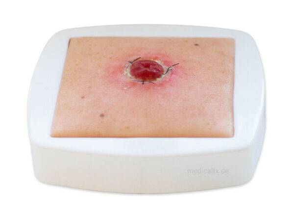 Das „Rahmenmodell Stoma mit Nahtdehiszenz" von MEDICAL FX Germany bietet eine hochpräzise Darstellung eines Stomas, bei dem eine Nahtdehiszenz aufgetreten ist. Dieses Modell ist i…