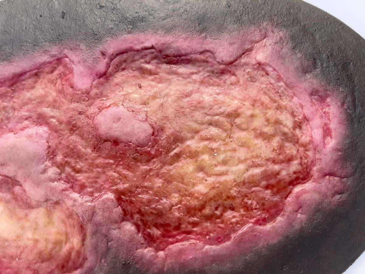 Das Modell „Stick-On Large Ulcus Cruris" von MEDICAL FX Germany simuliert ein großflächiges Unterschenkelgeschwür, typisch für venöse Insuffizienzen oder andere zirkulatorische Er…