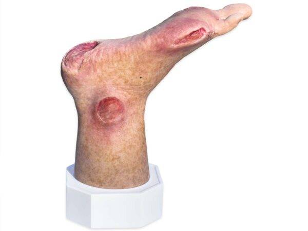 Das „Sockelmodell Zwei-Zehen-Fuß mit 6 Wunden“ von MEDICAL FX Germany präsentiert eine detailreiche Darstellung eines Fußes mit zwei verbliebenen Zehen und sechs verschiedenen Wun…