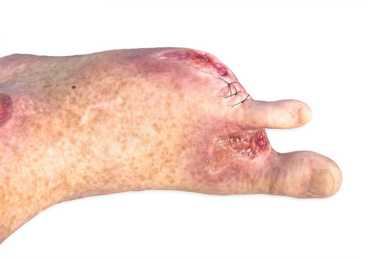 Das „Sockelmodell Zwei-Zehen-Fuß mit 6 Wunden“ von MEDICAL FX Germany präsentiert eine detailreiche Darstellung eines Fußes mit zwei verbliebenen Zehen und sechs verschiedenen Wun…