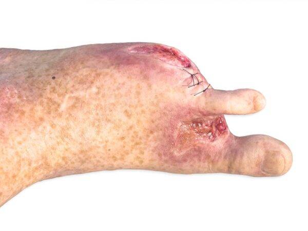 Das „Sockelmodell Zwei-Zehen-Fuß mit 6 Wunden“ von MEDICAL FX Germany präsentiert eine detailreiche Darstellung eines Fußes mit zwei verbliebenen Zehen und sechs verschiedenen Wun…