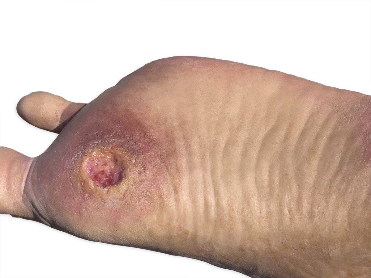 Das „Sockelmodell Zwei-Zehen-Fuß mit 6 Wunden“ von MEDICAL FX Germany präsentiert eine detailreiche Darstellung eines Fußes mit zwei verbliebenen Zehen und sechs verschiedenen Wun…