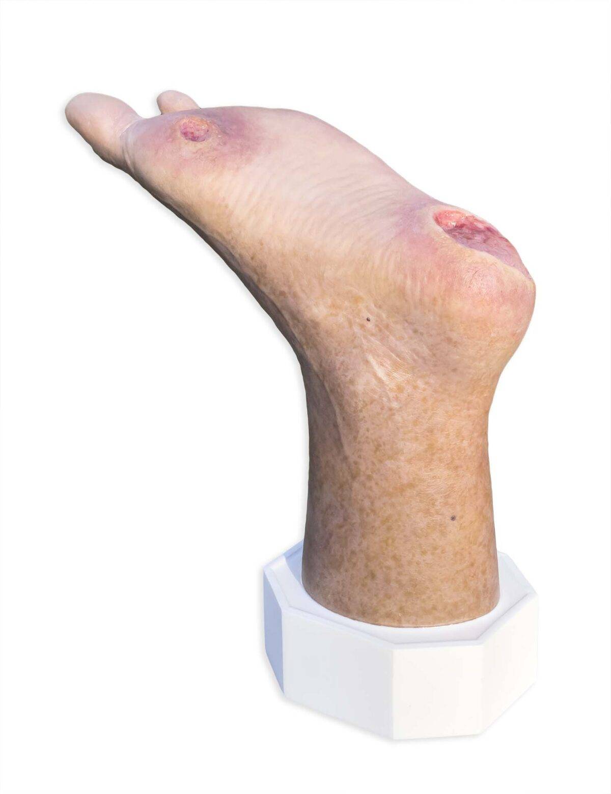 Das „Sockelmodell Zwei-Zehen-Fuß mit 6 Wunden“ von MEDICAL FX Germany präsentiert eine detailreiche Darstellung eines Fußes mit zwei verbliebenen Zehen und sechs verschiedenen Wun…