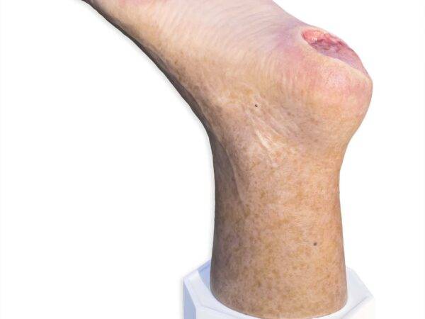 Das „Sockelmodell Zwei-Zehen-Fuß mit 6 Wunden“ von MEDICAL FX Germany präsentiert eine detailreiche Darstellung eines Fußes mit zwei verbliebenen Zehen und sechs verschiedenen Wun…