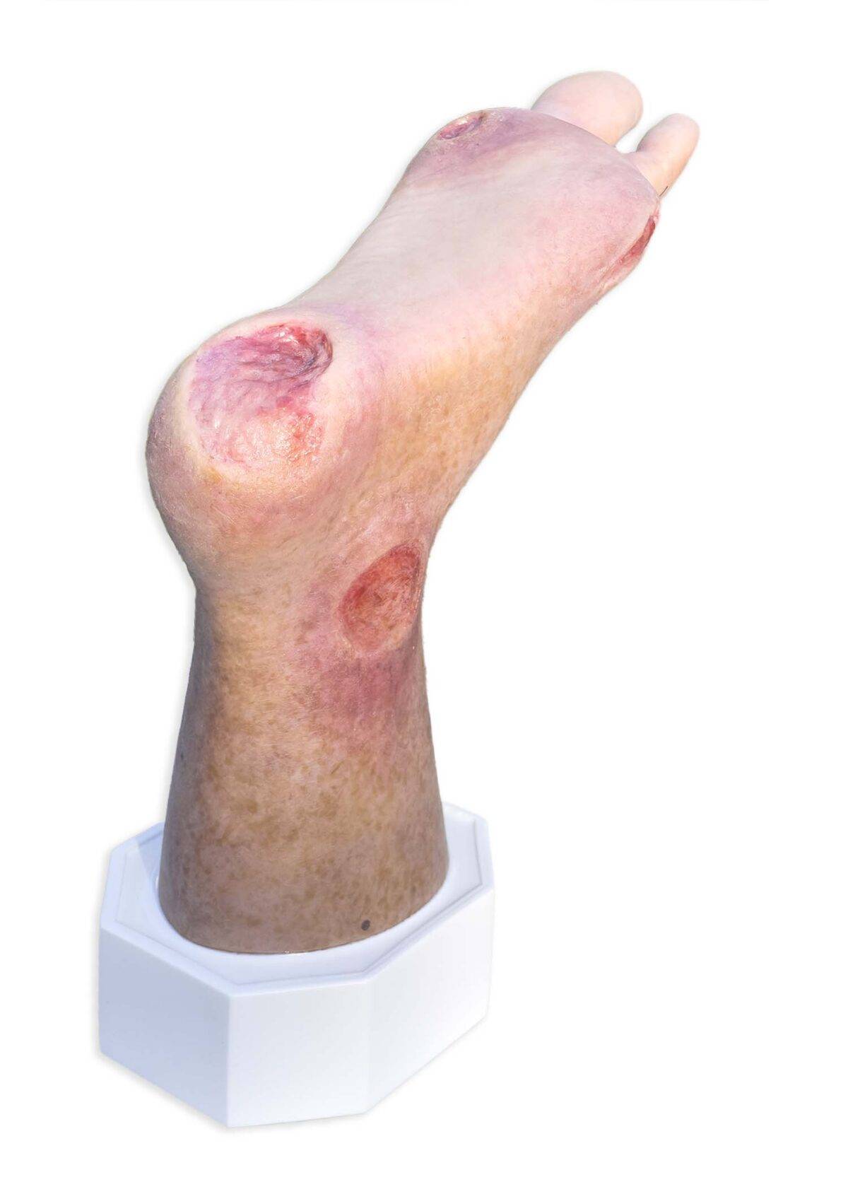 Das „Sockelmodell Zwei-Zehen-Fuß mit 6 Wunden“ von MEDICAL FX Germany präsentiert eine detailreiche Darstellung eines Fußes mit zwei verbliebenen Zehen und sechs verschiedenen Wun…