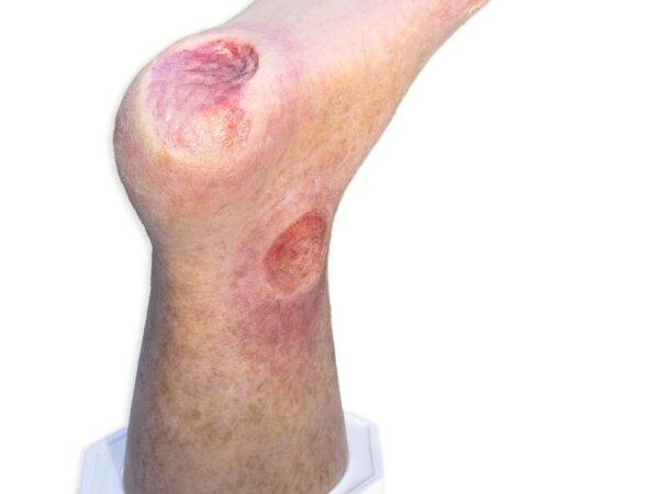 Das „Sockelmodell Zwei-Zehen-Fuß mit 6 Wunden“ von MEDICAL FX Germany präsentiert eine detailreiche Darstellung eines Fußes mit zwei verbliebenen Zehen und sechs verschiedenen Wun…