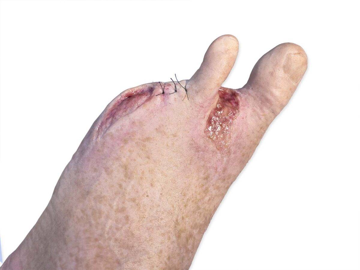 Das „Sockelmodell Zwei-Zehen-Fuß mit 6 Wunden“ von MEDICAL FX Germany präsentiert eine detailreiche Darstellung eines Fußes mit zwei verbliebenen Zehen und sechs verschiedenen Wun…