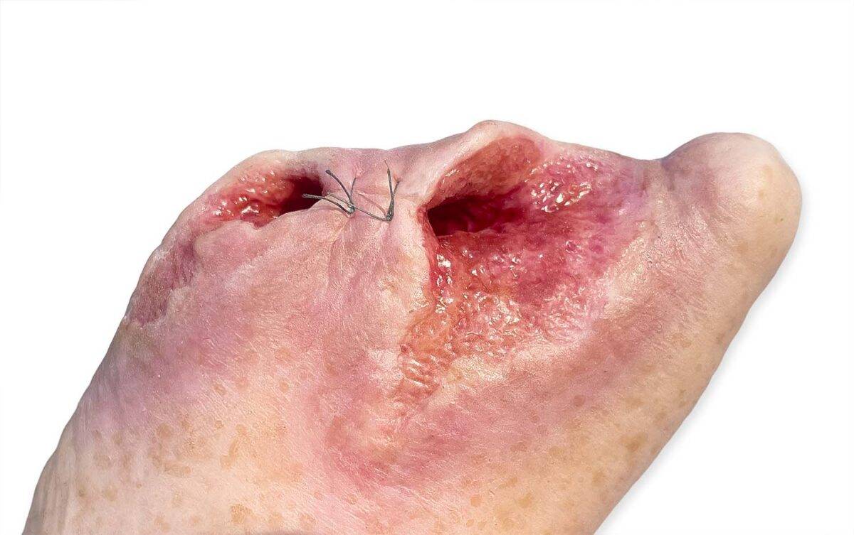 Das „Sockelmodell Diabetisches Fußsyndrom mit 7 Wunden" von MEDICAL FX Germany visualisiert präzise die Folgen des diabetischen Fußsyndroms. Die dargestellten Wunden umfassen Zehe…