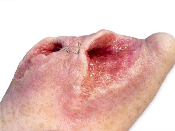 Das „Sockelmodell Diabetisches Fußsyndrom mit 7 Wunden" von MEDICAL FX Germany visualisiert präzise die Folgen des diabetischen Fußsyndroms. Die dargestellten Wunden umfassen Zehe…