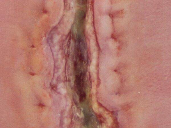 Das „Stick-On Medium OP Wunde, geöffnet"-Modell von MEDICAL FX Germany ist ein hochwertiges, mittelgroßes Silikonmodell zur Darstellung einer offenen Operationswunde. Es zeichnet…