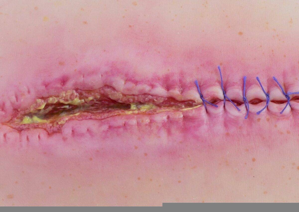 Das „Stick-On Medium OP Wunde, geöffnet"-Modell von MEDICAL FX Germany ist ein hochwertiges, mittelgroßes Silikonmodell zur Darstellung einer offenen Operationswunde. Es zeichnet…