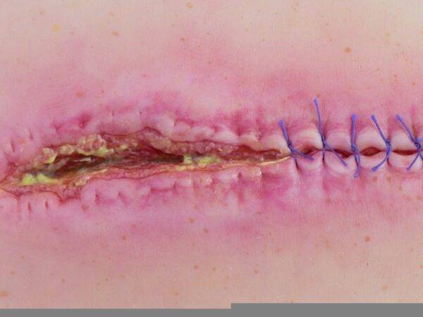 Das „Stick-On Medium OP Wunde, geöffnet"-Modell von MEDICAL FX Germany ist ein hochwertiges, mittelgroßes Silikonmodell zur Darstellung einer offenen Operationswunde. Es zeichnet…